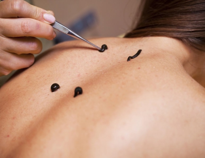 Гирудотерапия - Оздоровительные услуги - Санаторий «Летцы»